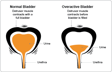 What Causes an Overactive Bladder and How Can You Control It?