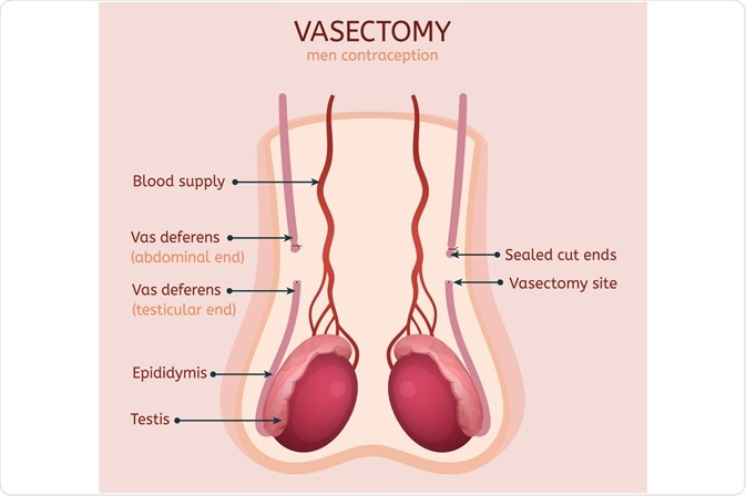 Vasectomy: What to Expect, Effectiveness & Healing Time