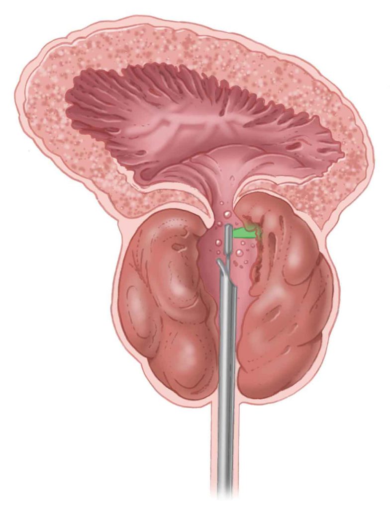 green light laser surgery prostate