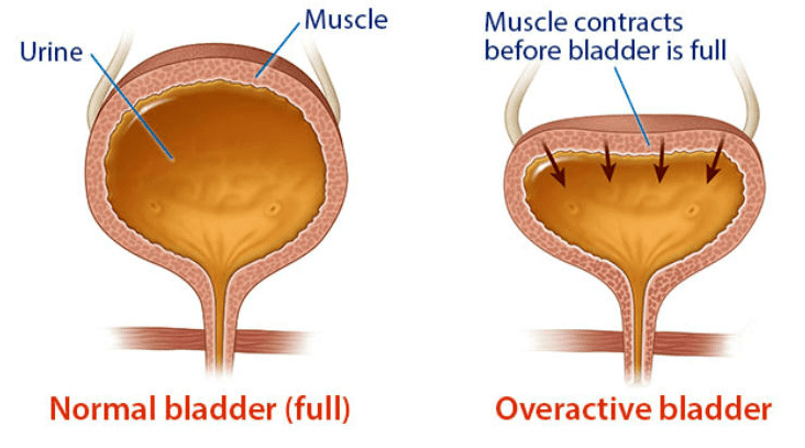 For Those With Overactive Bladder the Detrusor Muscle Contracts Prematurely