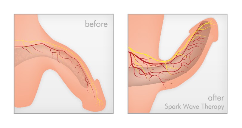 What is Shockwave Therapy Workout and how does it Work?