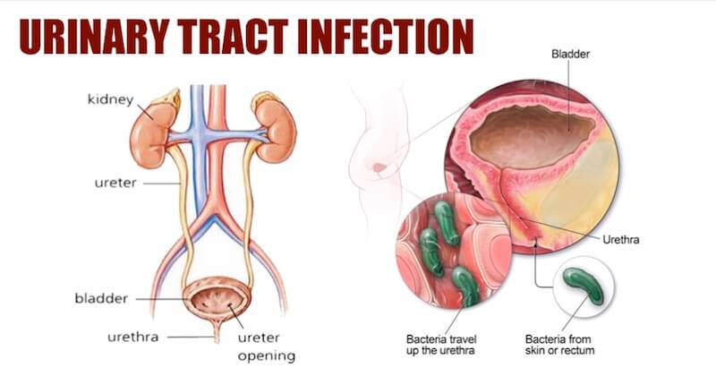 Urinary Tract Infections are Developed When Bacteria Travel Through the Urinary System