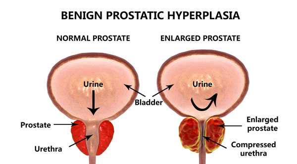 An Enlarged Prostate Blocks the Flow of Urine in the Urethra